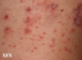 pemphigus foliaceus