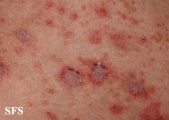 pemphigus foliaceus