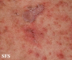 pemphigus foliaceus