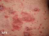 pemphigus foliaceus