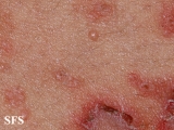 pemphigus foliaceus