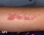 pemphigus foliaceus