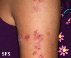 pemphigus foliaceus