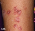 pemphigus foliaceus