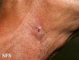 metastatic-laryngeal cell carcinoma
