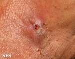 metastatic-laryngeal cell carcinoma