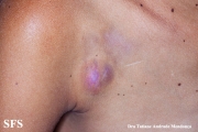 giant cell fibroblastoma