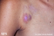 giant cell fibroblastoma