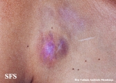giant cell fibroblastoma