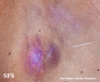 giant cell fibroblastoma