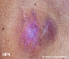 giant cell fibroblastoma