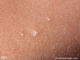 molluscum contagiosum