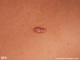 molluscum contagiosum