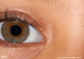 molluscum contagiosum