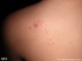 molluscum contagiosum