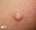 molluscum contagiosum