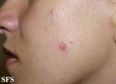 molluscum contagiosum