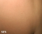 molluscum contagiosum