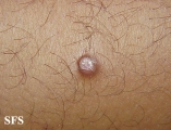molluscum contagiosum