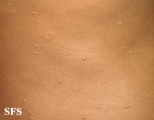 molluscum contagiosum