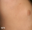molluscum contagiosum