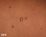 molluscum contagiosum