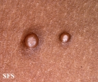 molluscum contagiosum