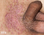 molluscum contagiosum