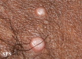 molluscum contagiosum