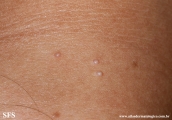 molluscum contagiosum