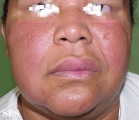 melkersson rosenthal syndrome
