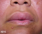 melkersson rosenthal syndrome