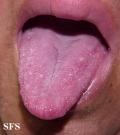 melkersson rosenthal syndrome