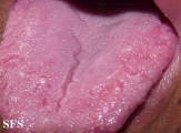 melkersson rosenthal syndrome
