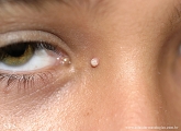 warts vulgaris