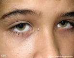 warts vulgaris
