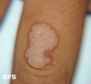 warts vulgaris
