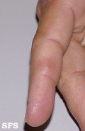 warts vulgaris