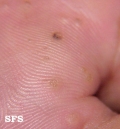 warts vulgaris