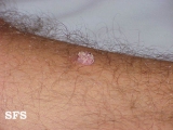 warts vulgaris