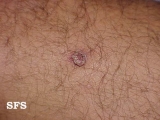 warts vulgaris
