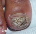 warts vulgaris