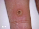 warts vulgaris
