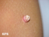 warts vulgaris
