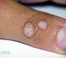 warts vulgaris