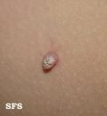 warts vulgaris