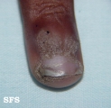 warts vulgaris