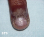 warts vulgaris