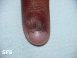 warts vulgaris