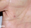 warts vulgaris
